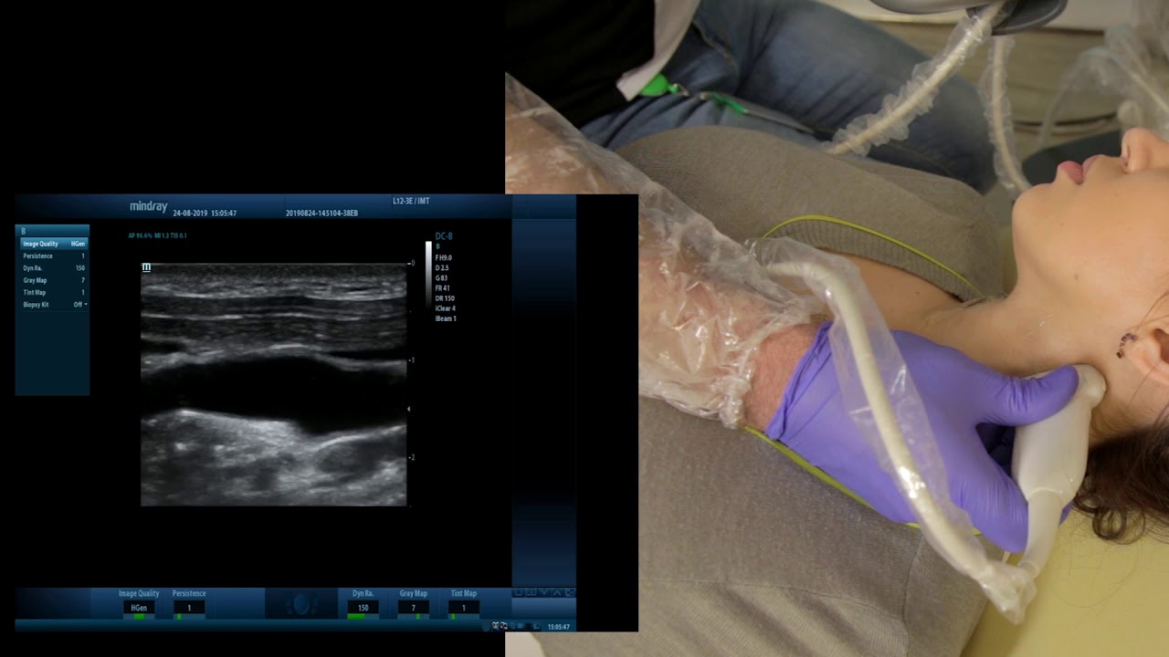 Мастер класс Исследование шейных сегментов сонных и позвоночных артерий