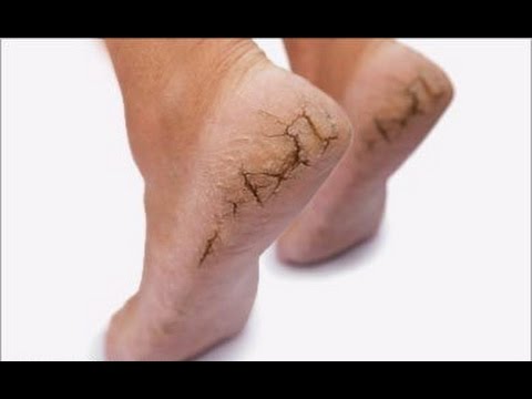 Kirurhiko paggamot ng pasalingsing kuko Sa kanyang mga kamay sa ilalim ng aking kuko burst capillaries bilang treat