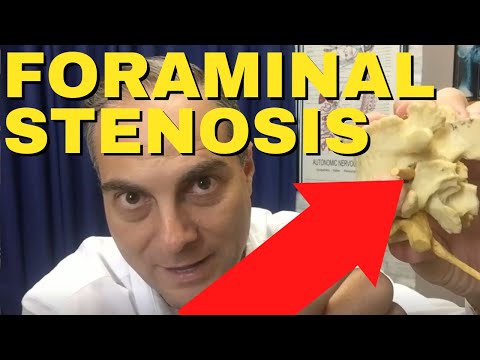 Ep23. Can Exercises Help Improve L4-L5 Foraminal Stenosis (L4 L5 Disc Bulge) Dr. Walter Salubro