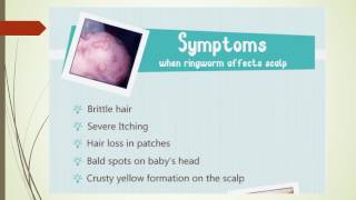 How to treat Ringworm in Babies - Curecity