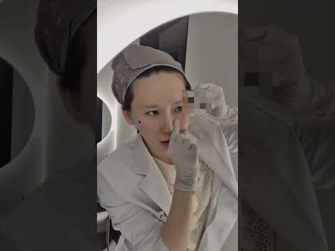 실리프팅 시술 영상 1