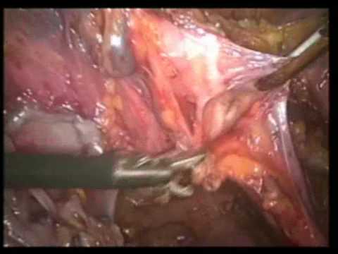 Minimally Invasive Total Uterus Excision