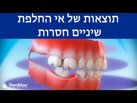 תוצאות של אי החלפת שיניים חסרות ©