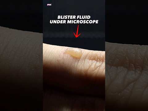Blister Fluid Under Microscope (White Blood Cells)