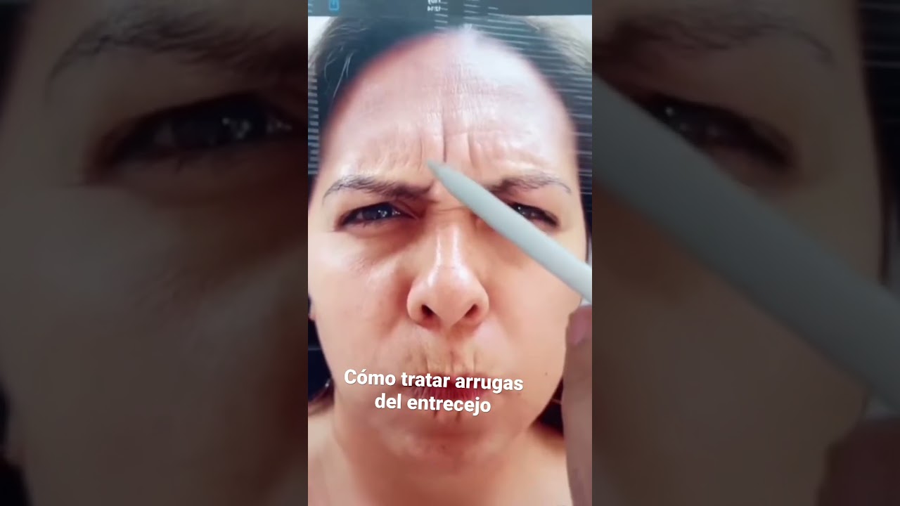 Cómo tratar arrugas del entrecejo.