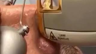 Nose Veins Laser Removal