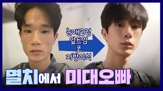 [남자성형브이로그] 멸치남에서 훈남으로?? 남자성형레전드? 눈매교정, 코, 지방이식