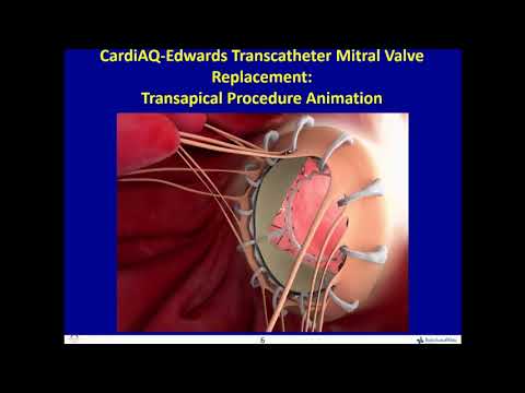 CardiaQ: Transseptal and Transapical MVR - David L. Brown, MD