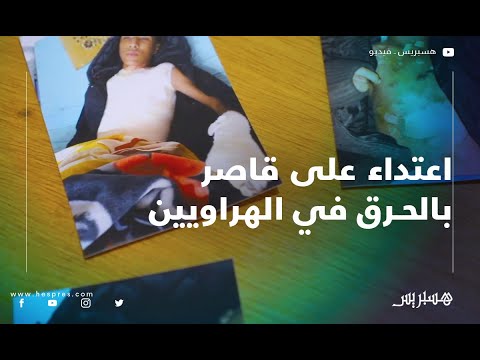 الهراويين.. قاصر يتعرض للحرق بالبنزين من طرف أقرانه‎