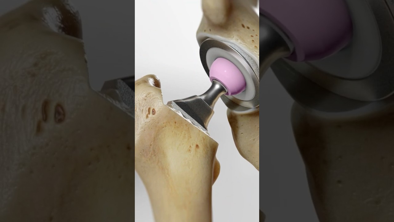 Total hip replacement explained (3D Animation)