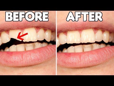 How To FIX A Chipped Tooth (Broken Tooth Repair Options)