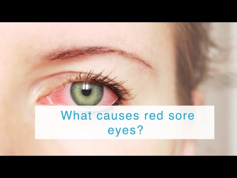 What causes red sore eyes?