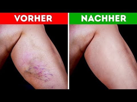 Die Deletion der Käfige der Haut bei der Schuppenflechte Die Pigmentflecke nach der Schuppenflechte