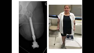 Dr. Rozbruch discusses Osseointegration of femur
