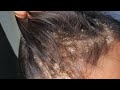 Dandruff Removal - Scalp Scratching