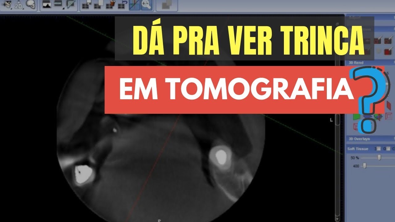 SAIBA SE É POSSÍVEL VER UMA TRINCA NA TOMOGRAFIA CONE BEAM - QUICK TIP ENDOLOVERS