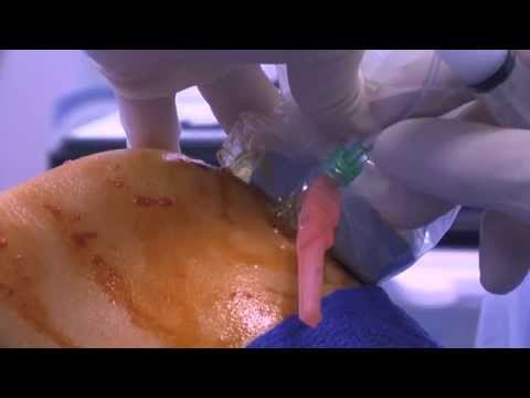 WATCH a Knee Joint Injection - LIVE!