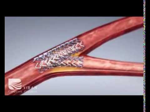 balloon angioplasty procedure cost and complications