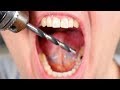 CAVITY GETS DRILLED