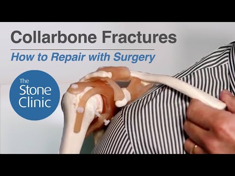 Collarbone Fractures [Minimally-Invasive Surgical Repair]