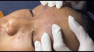 The Right Way To Pop Pimples #HoangMySpa196