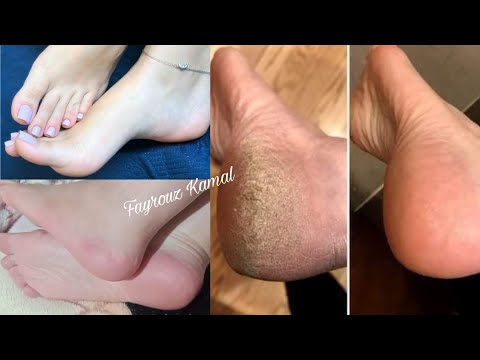 ربع كوب خل وقولي وداعآ لتشققات وخشونه القدمين مجربة مني شخصيآ تقشير . تبييض . ترطيب . بياض كاتلج هنا hana