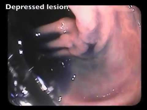 Endoscopic Signs of Cancer in a Flat Lesion - Summary