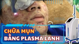 PlasmaMED: Tia Plasma lạnh điều trị mụn