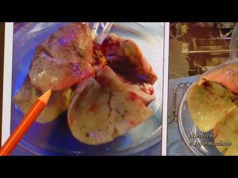 Come aumentare pene chirurgicamente e quanto costa Recensioni di Impaza per gli uomini