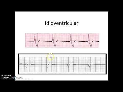 Idioventricular Rhythm