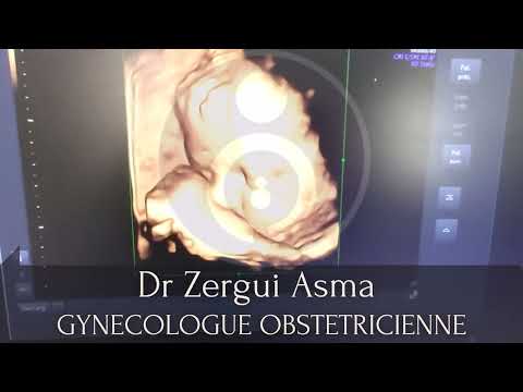 Echographie foetale 3d 7eme mois de grossesse