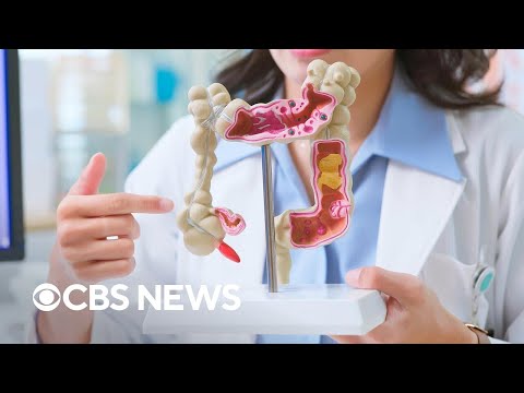 News-style illustration about colon cancer screening age being lowered to 45