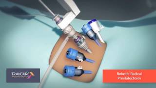 Robotic Prostatectomy - Most Advanced Prostate Cancer Treatment | SurgeryLog