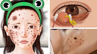 ASMR Remove Blackheads Under Arms, Pimples On Face - Pimple Squeezing Animation