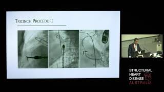 Emerging Percutaneous Tricuspid Valve Therapies – Dr Michael Michail