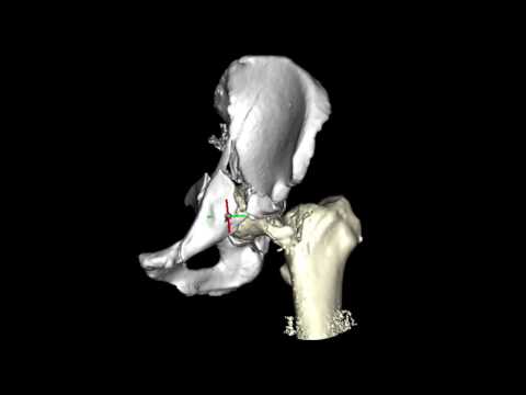 Pelvis fracture with proximal femoral