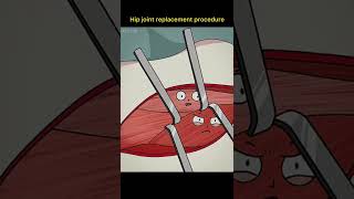 Download lagu Animasi pendek tentang sendi pinggul di ganti (medical procedure) mp3 Download lagu Animasi pendek tentang sendi pinggul di ganti (medical procedure) mp3