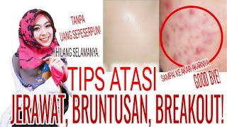 Download lagu TIPS ATASI JERAWAT, BRUNTUSAN, BREAKOUT TANPA MODAL !SAMPAI KE AKAR-AKARNYA.GAK DATENG-DATENG LAGI! mp3