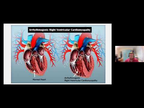 Understanding sudden cardiac arrest: why does it happen?