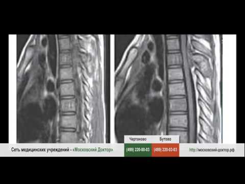 Киста внутреннего мениска коленного сустава чем лечить Методика бубновского плечевого сустава