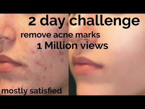 2 Day challenge remove pimple marks,dark spots,pigmentation|how to remove pimple & marks|sherag diys