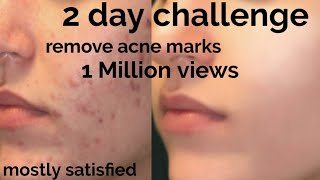 2 Day challenge remove pimple marks,dark spots,pigmentation|how to remove pimple & marks|sherag diys