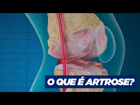 WHAT IS ARTHROSIS?