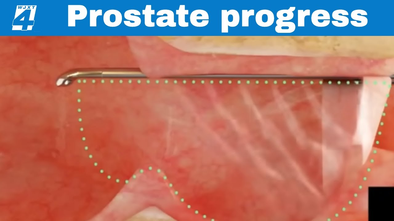 New treatment for enlarged prostates