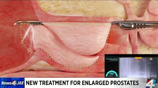 New treatment for enlarged prostates