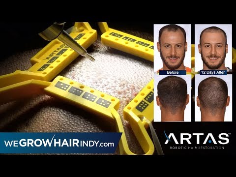 Best FUE - Nick's ARTAS Hair Transplant