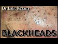 Best of Blackheads Removal by Dr Lalit Kasana / Repost