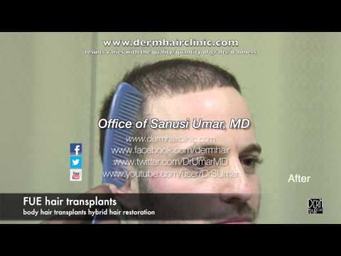 Results of Beard Hair Transplanted to Head -- Improved...