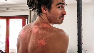 GROSS SUNBURN BLISTERS