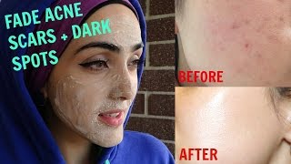 How To Get Rid of Acne Scars & Hyperpigmentation NATURALLY AT HOME| Tx for ALL Skin Types! ~ Immy